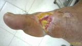 Nhân một trường hợp chấn thương bàn chân nhiễm trùng